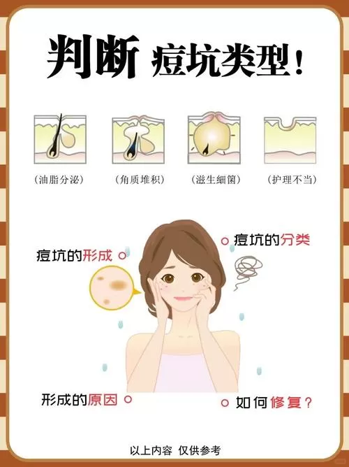 痘坑痘印是什么原因造成的