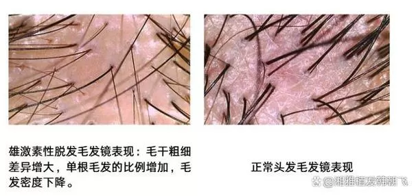 女性雄激素脱发能再长吗