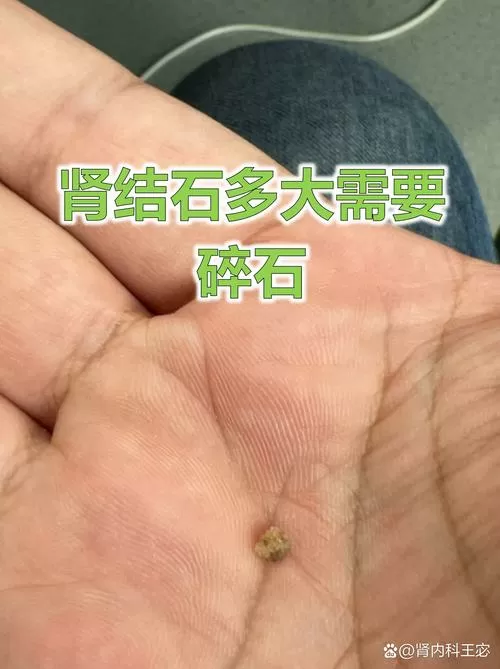 肾砂是什么意思截图