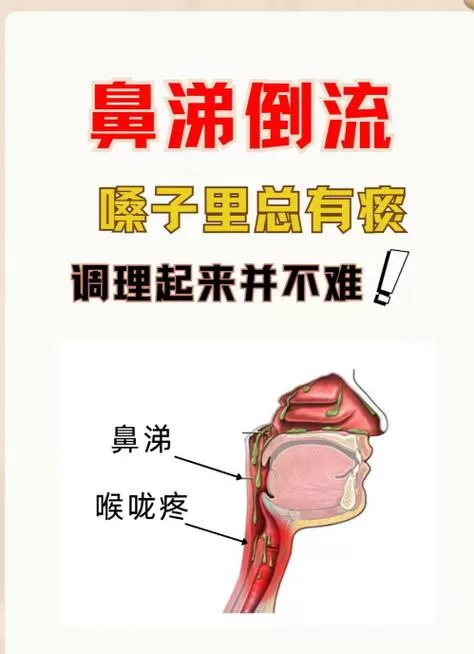 鼻涕多是鼻炎吗