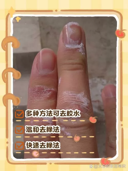 三秒胶粘到手上怎么办