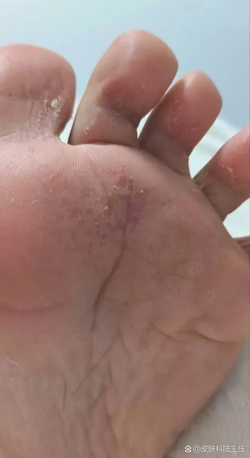 脚底很痒但又看不出来