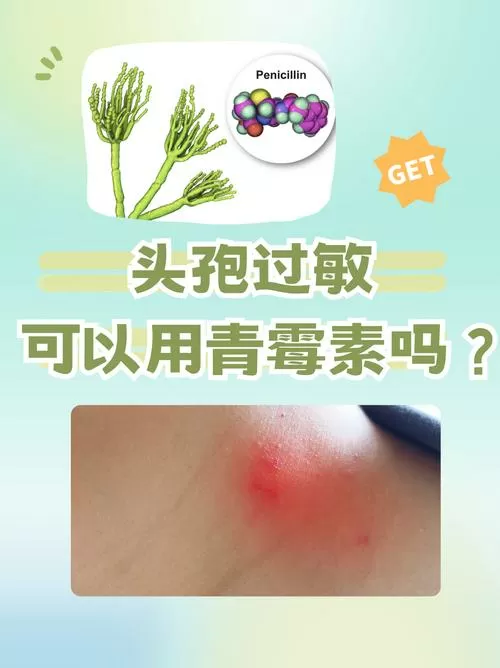 青霉素过敏麻烦吗