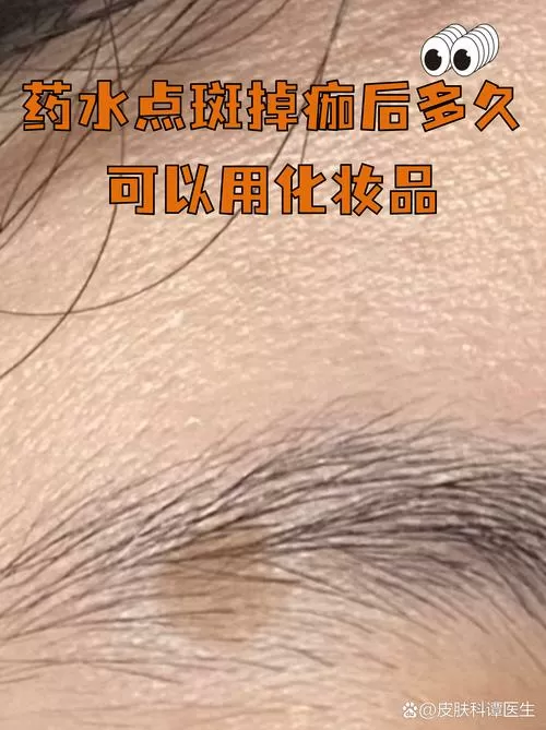点斑后多久才能恢复正常皮肤截图