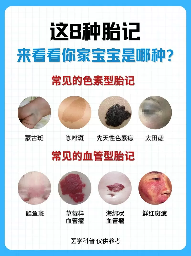 新生儿胎记怎么判断图片