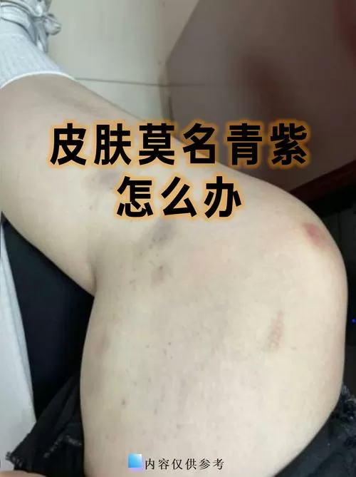 紫红色淤青多久能退