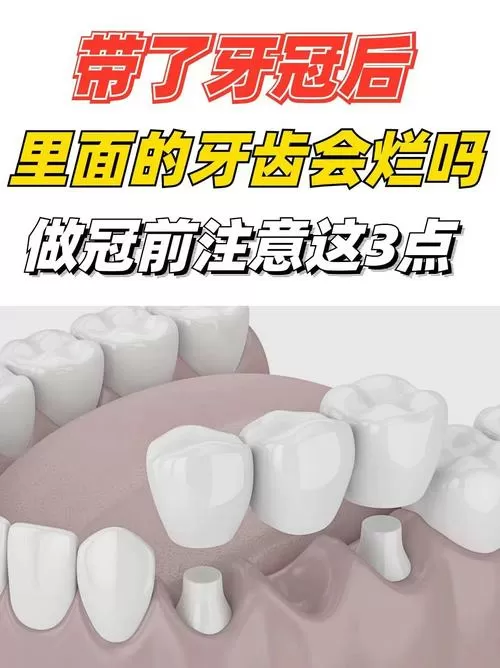 牙冠戴久了里面真牙会坏吗