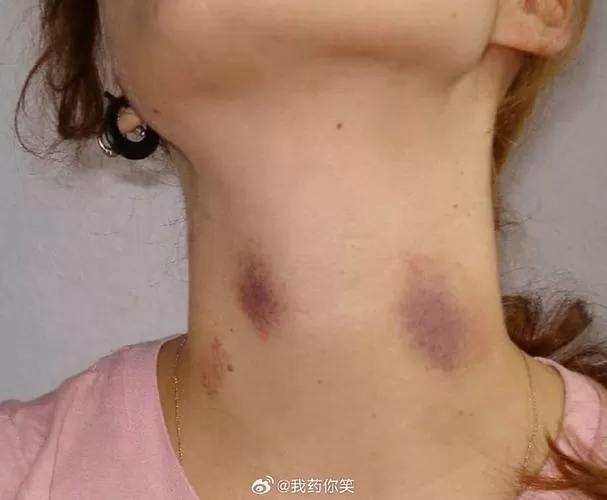脖子上无缘无故淤青像吻痕