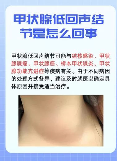 脖子淤血怎么消除