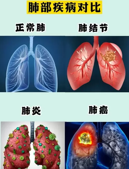 肺结节im和img的区别