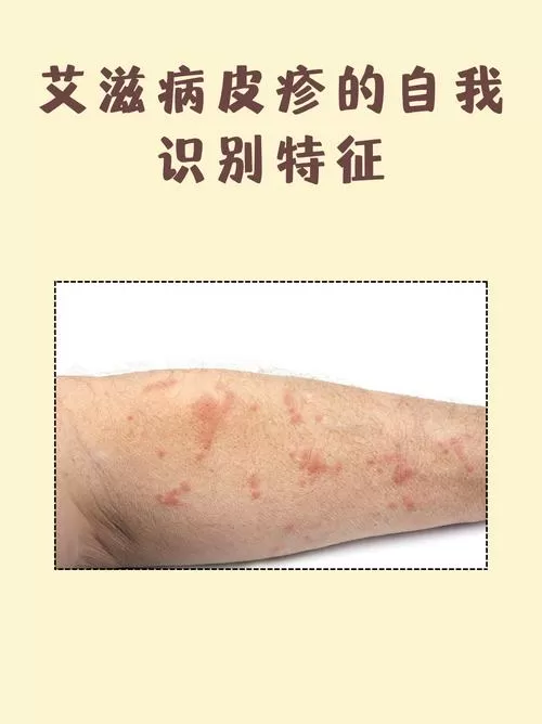 晚上痒是艾滋病初期症状吗