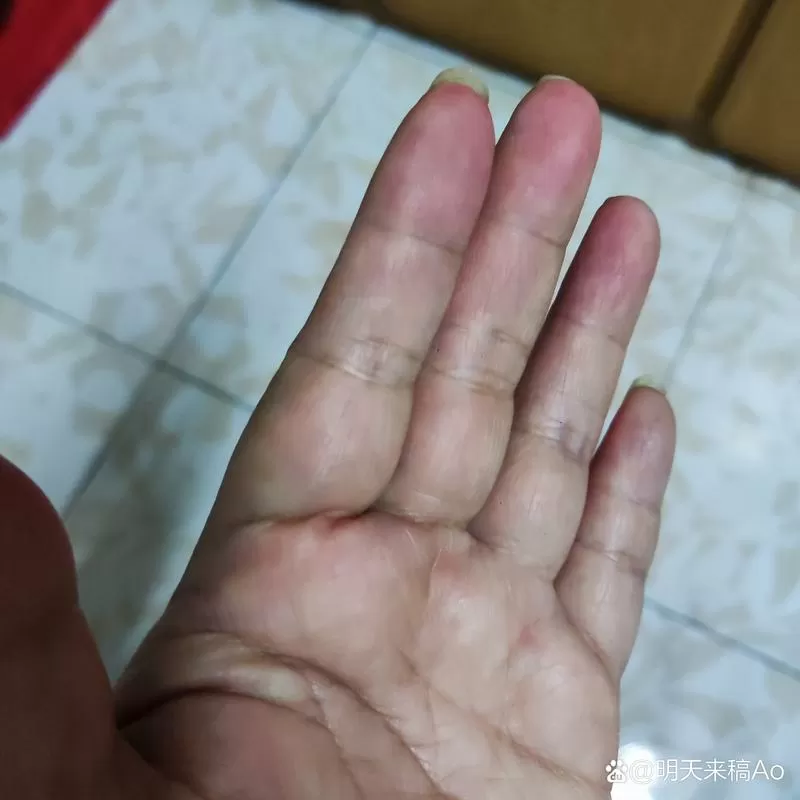 手指肚发红图片
