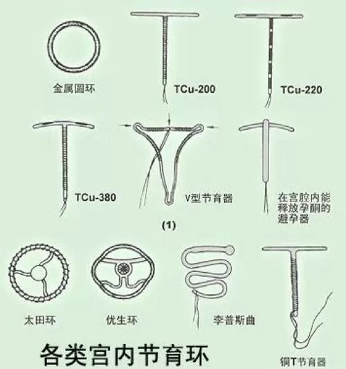 现在节育环哪种最好最安全