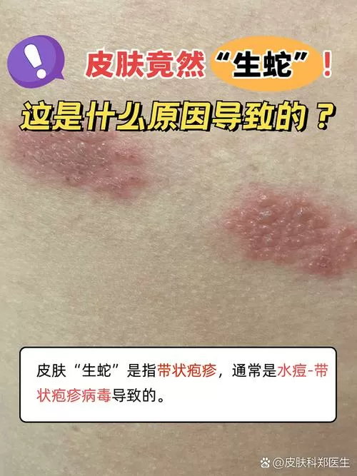 皮肤生蛇是怎么引起的