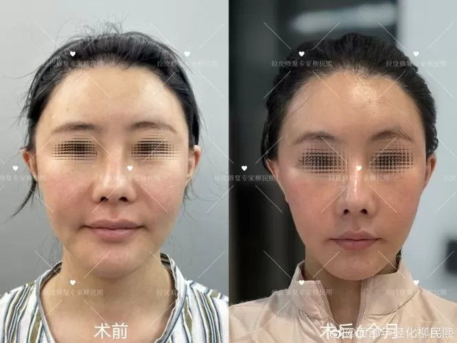 无痕拉皮是怎么做的