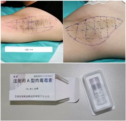 激光去狐臭视频全过程