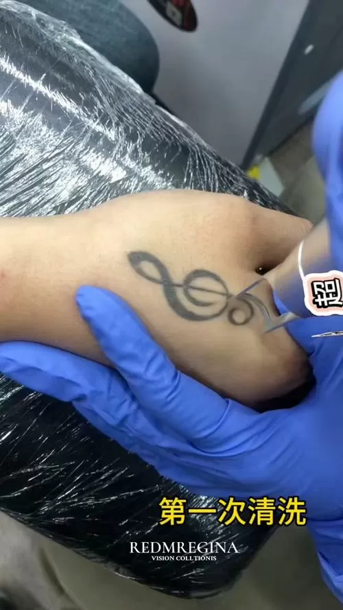 皮秒洗纹身和激光洗纹身有什么区别