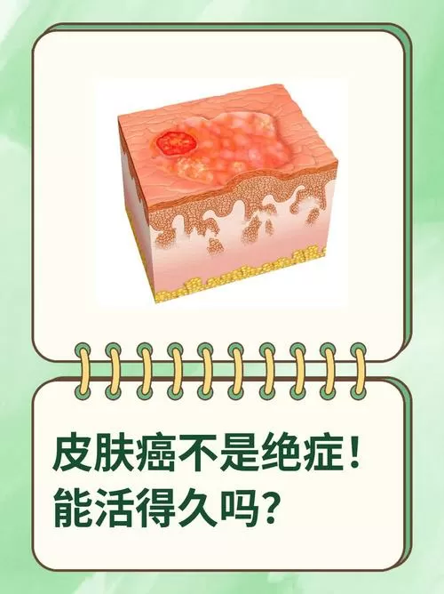 皮肤癌一般能活几年